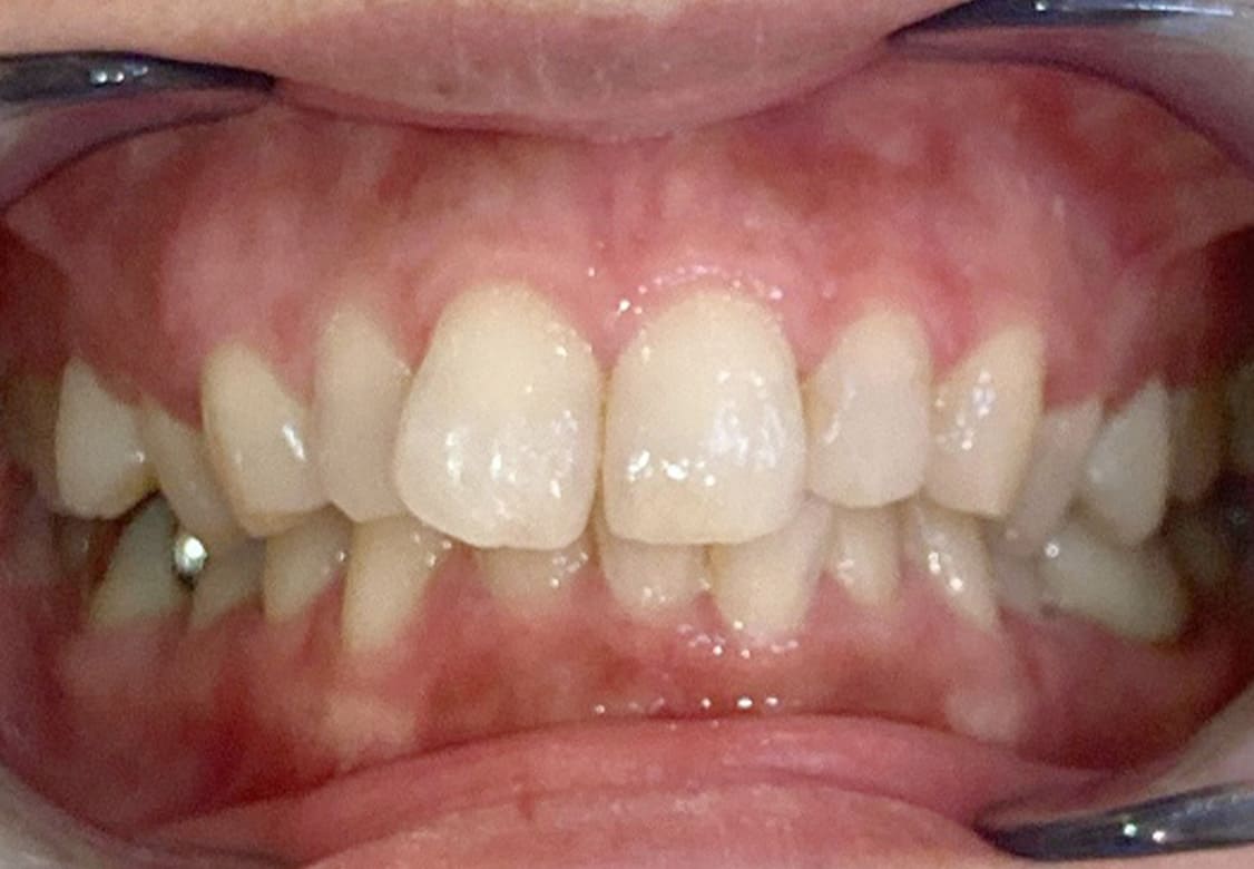 歯並びを改善すると様々なメリットがあります
